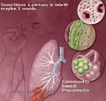 pneumonia