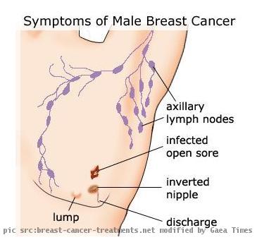 breast cancer