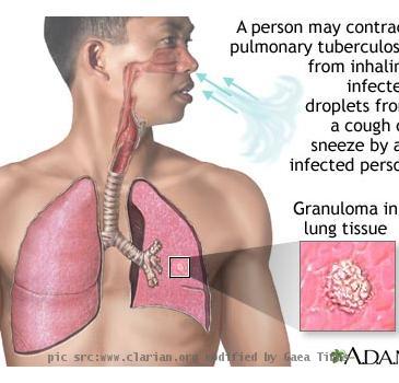 tuberculosis