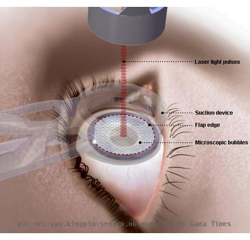 Re: <b><b>Lasik</b> surgery</b>