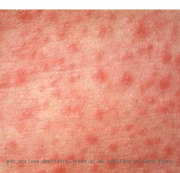 Measles