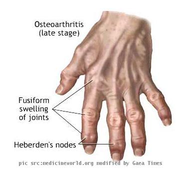 rheumatic diseases