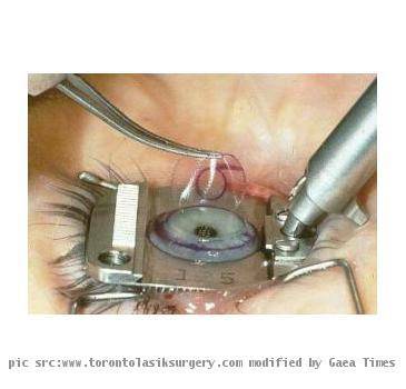 Comprehensive Study of Two Types of LASIK Procedures