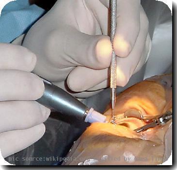 Cataract_surgery_57922_O