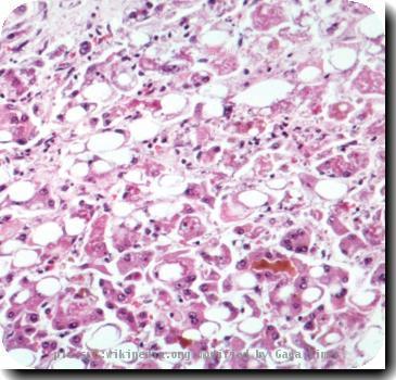 microscopy of liver,H&E stain, showing evidence of Alcoholic Hepatitis fatty change, cell necrosis, Mallory bodiesimage from PEIR - University of Alabama at Birmingham Department of Pathology