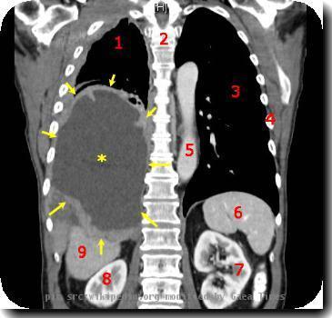 Malignant Mesothelioma, coronal CT scan.