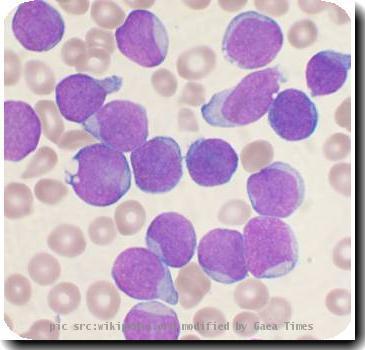 Acute_leukemia-ALL_60387_O