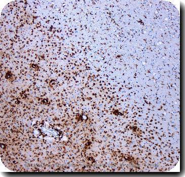 Photomicrograph of a demyelinating MS-Lesion. Immunohistochemical staining for CD68 highlights numerous macrophages (brown) . Orgininal Magnification 10x