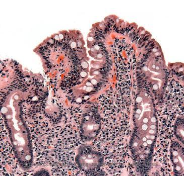 Biopsy of small bowel showing coeliac disease manifested by blunting of villi, crypt hyperplasia, and lymphocyte infiltration of crypts, consistent with Marsh classification III.  Released into pu