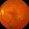 Description A fundus photo showing intermediate age-related macular degeneration.