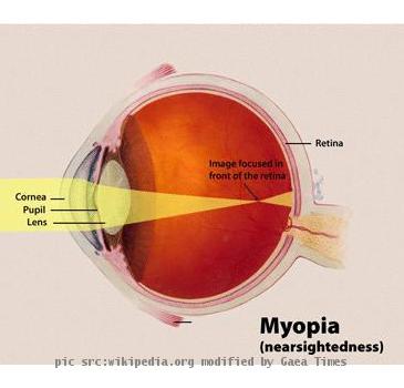 Diagram of Myopia in the human eye