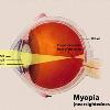 Diagram of Myopia in the human eye