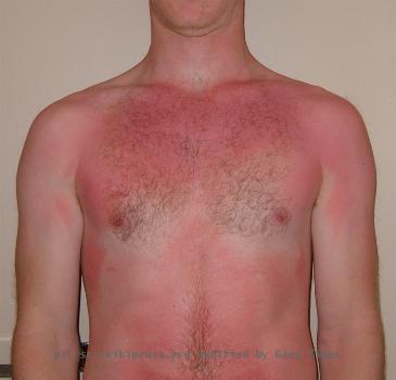 A moderate sunburn sustained over the course of four hours spent in the sun.