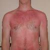 A moderate sunburn sustained over the course of four hours spent in the sun.