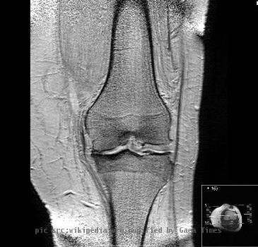 Gonarthrose-Knorpelaufbrauch_167292_O