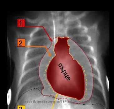 File:Cardiac tamponade 1