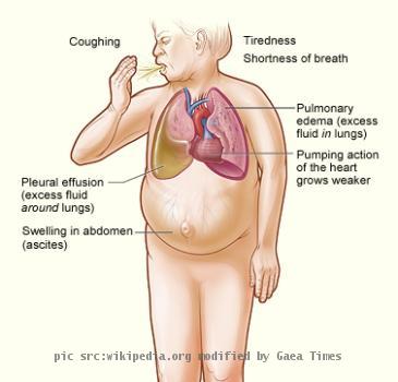 The illustration shows the major signs and symptoms of heart failure.