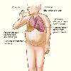 The illustration shows the major signs and symptoms of heart failure.