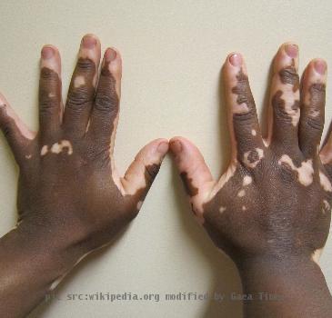 Vitiligo of the hand in a person with dark skin.