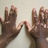 Vitiligo of the hand in a person with dark skin.