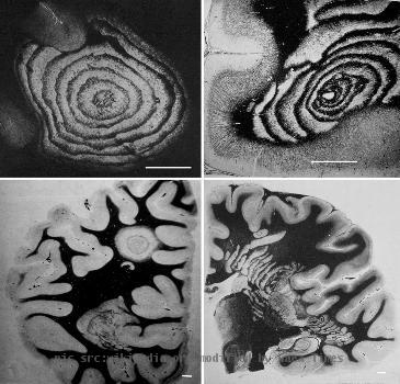 File:Balo sclerosis