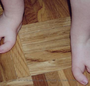 Ectrodactylie des deux pieds à un an