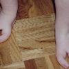 Ectrodactylie des deux pieds à un an