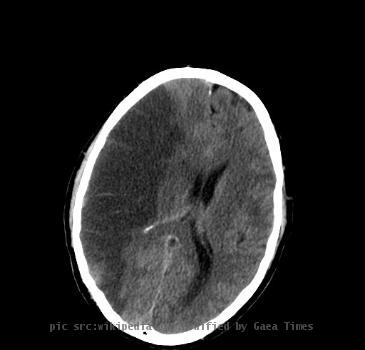 CT-scan of the brain with an infarct.