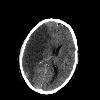 CT-scan of the brain with an infarct.