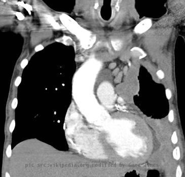 Coronal reformat of a CT of the chest in a patient with left sided mesothelioma. Note the extensive pleural mass with contraction of the left hemithorax. This image is from the full