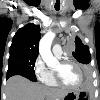 Coronal reformat of a CT of the chest in a patient with left sided mesothelioma. Note the extensive pleural mass with contraction of the left hemithorax. This image is from the full