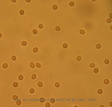 Microscopic hematuria Red blood cells in a urine sample seen under the microscope.