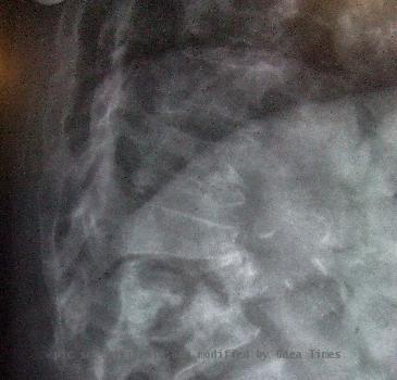 Lateral Spine X-ray Showing Wedge Fractures of L1/2; osteoporosis