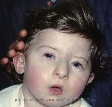 A patient with Prader_Willi_Syndrome