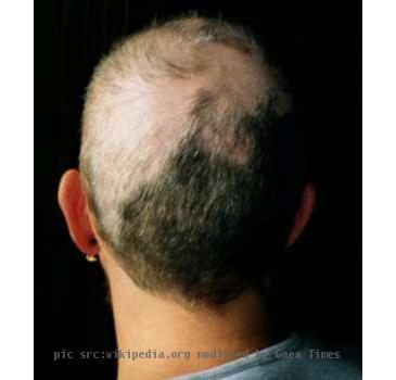 Trichotillomania