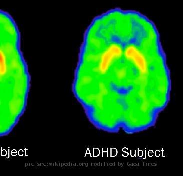 ADHD-DAT-300 Photo - ADHD brain