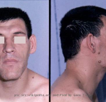 Facial aspect of a patient with acromegaly. The nose is widened and thickened, the cheekbones are obvious, the forehead bulges, the lips are thick and the facial lines are marked. The forehead and overlying skin is thickened, so