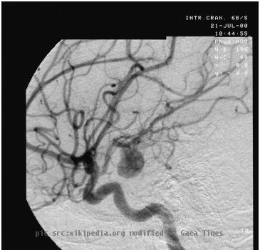 Angiography of an aneurisme in an cerebral artery.