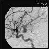 Angiography of an aneurisme in an cerebral artery.