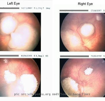 Retinoblastoma retina scan before and after chemotherapy