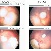 Retinoblastoma retina scan before and after chemotherapy