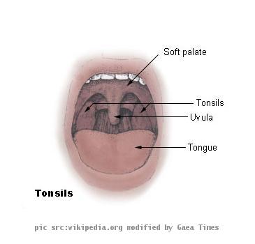 Diagram of the palatine tonsils from U.S. National Cancer Institute web site Uploaded on 18 December 2004 from U.S. National Cancer Institute trai