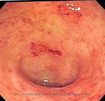 Endoscopic image of ulcerative colitis showing loss of vascular pattern of the sigmoid colon, granularity and some friability of the mucosa. -- Samir धर्म 0209, 3 October 2006 (UTC)