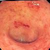 Endoscopic image of ulcerative colitis showing loss of vascular pattern of the sigmoid colon, granularity and some friability of the mucosa. -- Samir धर्म 0209, 3 October 2006 (UTC)