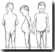 This is exactly what my dad s body shape was    aside from the little kid head  Huge pot belly  hard as rock   no butt  Just thought I d throw that out there as a point of conversation  j  img http   www pigur co il imgceliac celiac jpg  img