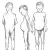 This is exactly what my dad s body shape was    aside from the little kid head  Huge pot belly  hard as rock   no butt  Just thought I d throw that out there as a point of conversation  j  img http   www pigur co il imgceliac celiac jpg  img