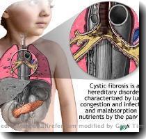 Pictures   Images Cystic Fibrosis