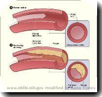 in the blood  When plaque builds up in the arteries  the condition is called atherosclerosis  ATH er o skler O sis   Atherosclerosis Figure A shows a normal artery with normal blood flow  Figure B shows an artery with plaque buildup  Plaque narrows the arteries and reduces blood flow