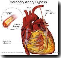 blood is then returned to the body  The main aorta is clamped off  cross clamped  during CABG surgery to maintain a bloodless field and to allow bypasses to be connected to the aorta  The most commonly used bypass vessel is the saphenous vein from the leg  Bypass grafting involves sewing the graft vessels to the coronary arteries beyond the narrowing or blockage  The