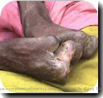 Symptoms of Leprosy The most common symptoms of leprosy are  Symptoms of Leprosy  1